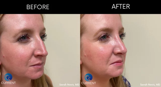 Rhinoplasty before and after of someone that had a dorsal hump removal