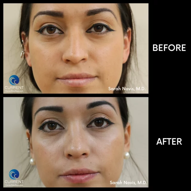 Front angle of Rhinoplasty before and after of dorsal hump removal surgery