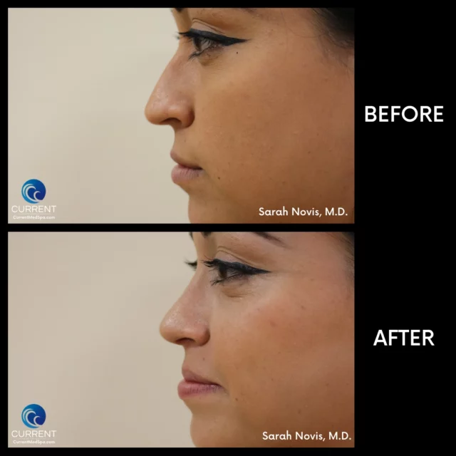 Profile angle of Rhinoplasty before and after of dorsal hump surgery at Current Medspa in North Myrtle Beach
