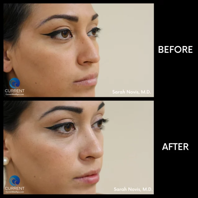 Rhinoplasty before and after of dorsal hump removal surgery